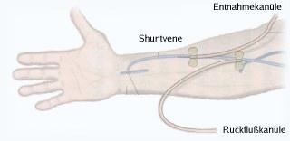 Unterarmshunt